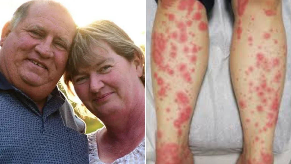 mother-of-ten-airlifted-to-icu-after-severe-antibiotic-reaction