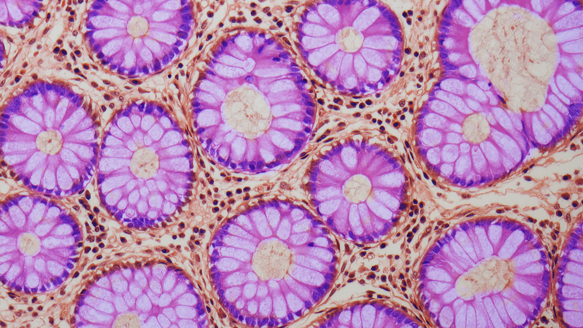 new-research-links-gut-changes-to-increased-cancer-risk