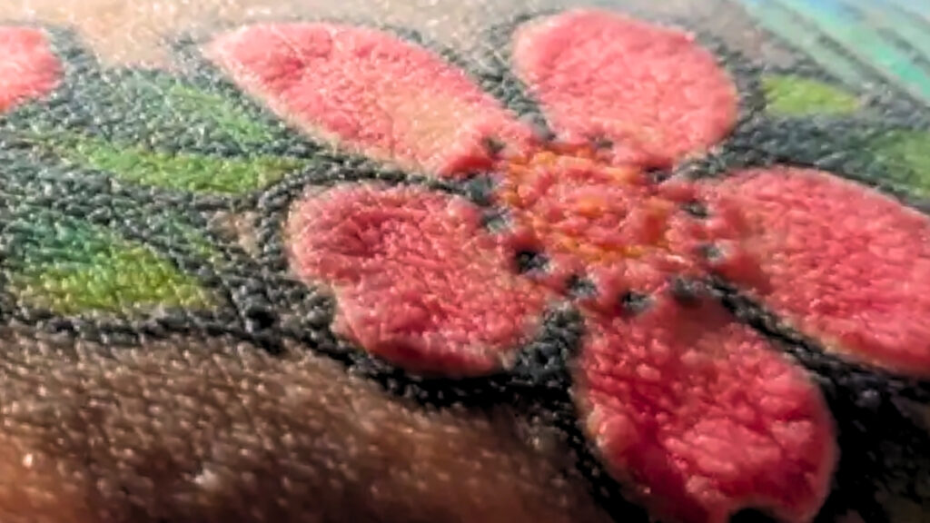 polish-man-s-tattoo-sparks-severe-health-crisis-and-surgery