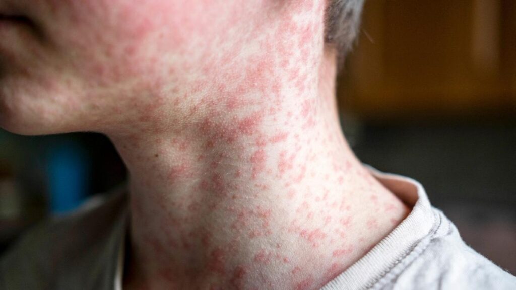 Measles viral disease, human skin covered with measles rash, vaccination concept