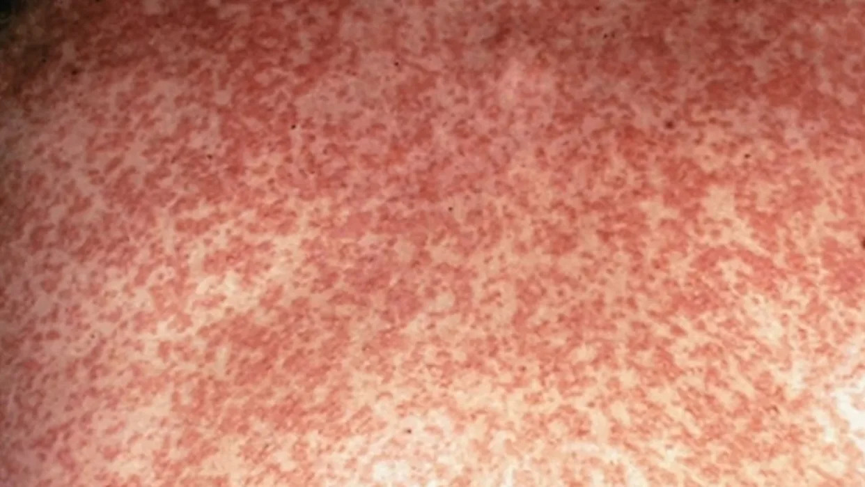 health-authorities-warn-of-measles-risk-in-new-south-wales